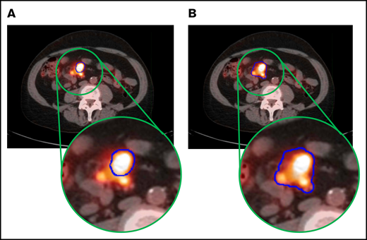 Example of a case of MTV calculations in a patient via the 2 investigated MTV estimation methods. PET images in the MTV semiautomated method (A) and MTV manual method (B), with tumor outlined in blue.