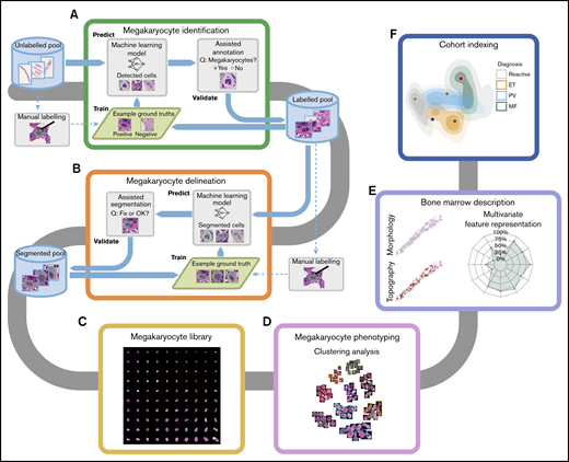 Overview of the computational pipeline for the disease cohort analysis of MPNs. We characterized the megakaryocyte morphology and topography of each BMT sample. To effectively build an annotated library of megakaryocytes, assisted annotation tools for identification (A) and delineation (B) have been developed. (C) A library of 62 479 annotated megakaryocytes from reactive and MPN samples was generated, of which 37 284 have been validated by a hematopathologist. (D) Clustering analysis performed on the library of megakaryocytes identified candidate phenotypes. (E) The phenotypic and topographical profile of megakaryocytes was extracted and used to create abstract representations of each trephine sample. (F) Based on these abstract representations, the analyzed samples can be represented in 2-dimensional space with new samples indexed to annotated disease cohorts.