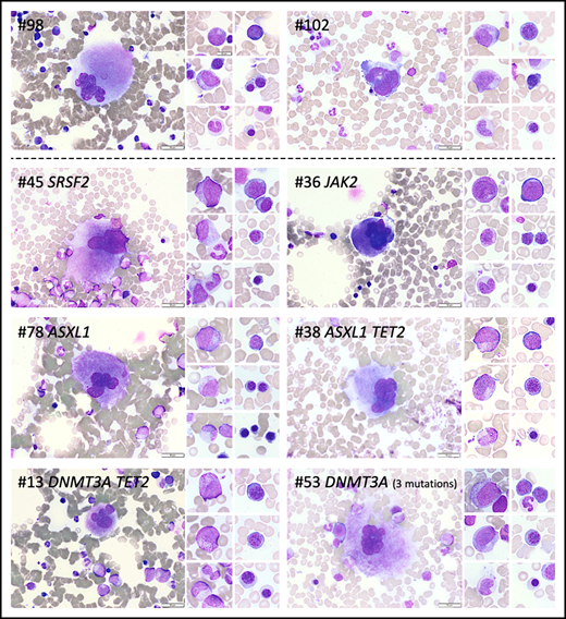 Cytomorphologic aspects of the BM of individuals with or without CH. BM photos from 2 volunteers without CH (#98 and #102) and 6 volunteers with CH (#13, #36, #38, #45, #53, #78). Representative cells from the megakaryocytic, granulocytic, and erythroid lineages are shown. Mutated genes are indicated at top of each panel. Scale bars represent 50 µm.