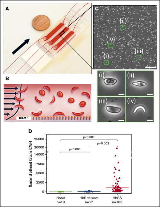 The microfluidic assay used to assess adhesion of sickle RBCs to immobilized ICAM-1 under physiological flow conditions. (A) Assembled microdevice containing 3 separate microchannels, each functionalized with ICAM-1. Arrow indicates the flow direction. (B) Recombinant human ICAM-1 protein was immobilized on the microchannel surface via a cross-linker agent, GMBS, to ensure consistent protein coverage throughout the microchannel, as well as to prevent protein dissociation from the surface at high shear rates. (C) Representative image obtained following an adhesion experiment (upper panel). Enlarged images of the green boxes are shown (lower panel). Adherent sickle RBC populations possessed distinct morphologies: (i) RBC with a characteristic biconcave morphology and elongated elliptic shape, (ii) RBC with a nearly absent biconcave morphology and further impaired elliptic shape, (iii) RBC with no biconcave morphology and elongated elliptic shape, (iv) highly sickled RBC with no biconcave morphology. (D) The number of adherent RBCs was significantly greater in samples from subjects with HbSS > HbS variant > HbAA. The horizontal lines represent the means; ‘‘n’’ represents the number of blood samples tested. A total of 106 blood samples were tested from 55 subjects with HbSS SCD. The scale bars are 5 μm.