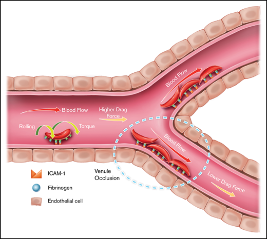 Proposed ICAM-1–mediated HbSS RBC adhesion mechanism in SCD. Results are consistent with a model of firm adhesion of HbSS RBCs to the vasculature in the postcapillary venules under low physiological shear, which may be mediated by initial rolling adhesion of RBCs in the capillary under high physiological shear, facilitated by ICAM-1. RBCs may form firm attachment with ICAM-1 near the low shear sites throughout the microvasculature, contributing to impaired local flow conditions, as illustrated by the dashed oval.