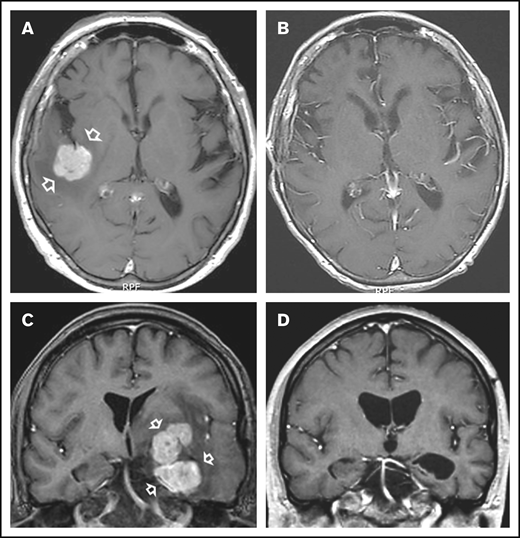 Examples of responses to R-CHOP preceded by NGR-hTNF. (A) Gadolinium-enhanced T1-weighted scan shows a large homogeneous enhancing lesion in the right parietal lobe (arrows) in a 65-year-old man at second relapse after high-dose methotrexate and after salvage high-dose ifosfamide-based therapy plus WBRT. (B) Tumor regression after 4 courses of experimental treatment. (C) Gadolinium-enhanced T1-weighted scan shows a large polylobate, enhancing lesion infiltrating the basal ganglia, diencephalon, and left temporal lobe (arrows) in a 39-year-old man with PCNSL refractory to previous high-dose methotrexate-based chemoimmunotherapy. (D) Tumor regression after 4 courses of experimental treatment.