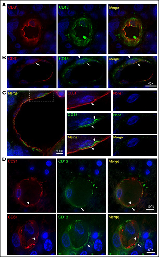 Expression of CD13 by endothelial cells and pericytes in primary CNS lymphoma vasculature. High-resolution wide-field co-immunofluorescence analysis of PCNSL tissue sections from 2 enrolled patients. The sections were stained with a polyclonal anti-CD13 antibody (green) and polyclonal anti-CD31, a marker of endothelial cells (red). Nuclear staining with 4′,6-diamidino-2-phenylindole (DAPI; blue). (A-C) Examples of vessels with CD13+ endothelial cells (arrows, yellow in the merged figure) and CD13+ mural cells (arrowheads, green, likely pericytes). See also supplemental Movie 1 for z-stack images of the vessel reported in panel A. (C) Central panel: electronic enlargement of the highlighted area (dashed rectangle) of the vessel shown in the left panel. Right panel (control): a consecutive tissue section with secondary antibodies alone, showing lack of staining. (D) Examples of vessels with CD13+ mural cells (arrows, green) and CD13– endothelial cells (arrowheads, red) in the merged figure. Scale bar, 5 µm; magnification is shown in each panel.