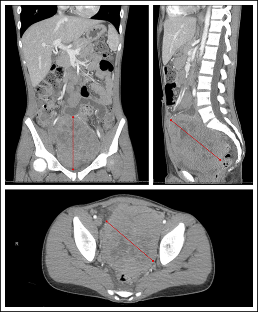 Abdominal computed tomography imaging demonstrating a large heterogeneous mass centered within the pelvis and lower abdomen in a child with BL. Red lines represent the extent of the lymphoma mass from its outer edges.