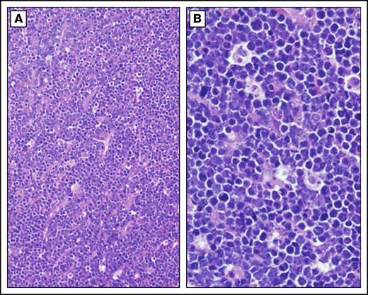 Burkitt lymphoma histopathology. Representative histological images from a child with BL demonstrating tumor morphology on hematoxylin and eosin–stained biopsy at low-power (A) and high-power (B) magnification.