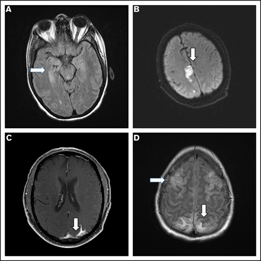 Representative MRI imaging features. (A) Encephalitis (T2/FLAIR axial image). (B) Stroke (diffusion-weighted axial image). (C) Leptomeningeal disease (postcontrast T1-weighted axial image). (D) PRES (T2/FLAIR axial image).