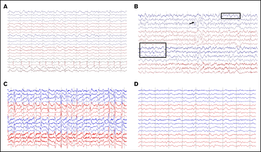 Representative patterns observed on EEGs. (A) Diffuse slowing and cardiac arrythmia. (B) Focal slowing indicated by boxes and epileptiform discharges indicated by arrow. (C-D) Nonconvulsive status epilepticus (C) and response to 2 mg IV lorazepam (D). Montage shown: longitudinal bipolar, left central/right central, left temporal/right temporal chain: 70 µV/cm voltage, 30 mm/s.