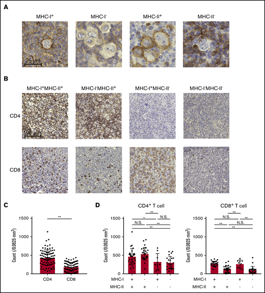 cHL exhibits MHC-II expression accompanied by CD4+T-cell infiltration. (A) Representative staining pictures for MHC-I and MHC-II. IHC was conducted on FFPE sections (3 µm thick) from 85 patients with cHL. (B-D) CD4+ and CD8+ T-cell infiltration according to the expression of MHC-I and MHC-II. IHC was conducted as described in panel A. Five fields (0.0625 mm2) containing HRS cells were randomly selected and counted for each slide. The average of the 5 area counts for each patient was used for statistical analysis. Representative immunohistochemically stained images (B) and summaries of the counts of CD4+ T cells and CD8+ T cells (C) are shown. (D) Summaries of cell counts according to the expression of MHC-I and -II are shown. *P < .05; **P < .01. N.S., not significant.