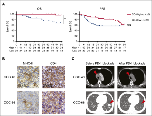 High CD4+T-cell infiltration, a favorable prognostic factor in cHL, is associated with antitumor effects induced by PD-1 blockade therapy. (A) OS and PFS according to CD4+ T-cell infiltration. The survival of 76 patients with cHL who received first-line standard chemotherapy (doxorubicin, bleomycin, vinblastine, and dacarbazine) was examined. The cohort was divided by a cutoff value (high, CD4 ≥425, vs low, <425) determined by the ROC curve. **P < .01. (B-C) Representative staining pictures for MHC-II and CD4 (B) and computed tomographic imaging (C) in patients with cHL who received anti-PD-1 mAb (nivolumab). IHC was conducted on FFPE sections (3 µm thick). Patient CCC-43 (64-year-old male) received nivolumab monotherapy as fourth-line therapy. He achieved a partial response after 8 cycles of nivolumab (arrowheads), and his performance status improved from 3 to 2. Patient CCC-66 (56-year-old male) received nivolumab monotherapy as fourth-line therapy and achieved a PR after 8 cycles of nivolumab (arrowheads).