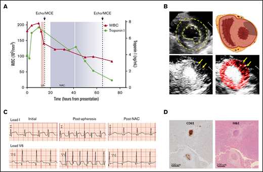 Clinical and imaging data highlighting manifestations of ponatinib-mediated coronary thrombotic microangiopathy. (A) Temporal trends for WBC count (red triangles) and serum troponin I (green circles) relative to the timing of leukapheresis (LA), echocardiography with MCE (dashed lines), and initiation of NAC (shaded area extending to 2 half-lives after last dose). (B) Transthoracic echocardiography demonstrating left ventricular endocardial and epicardial borders (dashed lines) in the midventricular parasternal short-axis plane on noncontrast 2-dimensional imaging and a schematic showing cardiac orientation with gray region overlying the anterolateral region where perfusion was abnormal (upper panels) and corresponding MCE perfusion imaging (bottom panels) prior to NAC treatment with a tissue-subtraction algorithm whereby opacification occurs only where microbubble contrast agent is present, demonstrating patchy regions lacking perfusion (arrows) in the anterolateral region. The bright central region represents the opacified ventricular cavity. The color-coded image is provided to highlight regions lacking perfusion within the confines of the left ventricular borders. (C) Lead I and V6 tracings from ECGs performed on initial presentation, after leukapheresis and approximately 24 hours after initiation of NAC (see supplemental Figure 1 for the full 12-lead ECG on presentation). (D) Postmortem immunohistochemistry for platelet CD61 (β3-integrin) and corresponding hematoxylin and eosin staining showing evidence recent platelet-rich microvascular thrombus and mural hyperplasia involving arterioles. Brown indicates secondary peroxidase staining.