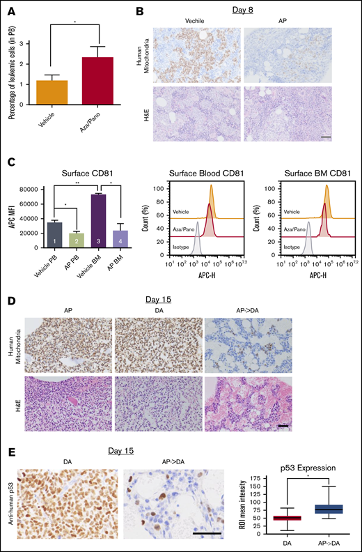 Aza/pano treatment reduces ALL cell adhesion and BM load. (A) Peripheral blood analysis of vehicle-treated and aza/pano-treated mice identifying CD10+ human leukemic cells (NTPL-87). *P < .05. (B) Mouse femur sections collected at day 8 (following completion of AP treatment; Figure 6A) were stained with hematoxylin and eosin or anti-human mitochondria antibody to detect human cells (brown). Scale bar, 50 μm. (C) Graphical representation and representative plots of CD81 surface expression on human leukemic cells from peripheral blood (PB) and bone marrow (BM) in mice transplanted with WT (n = 2) or CD81KO (n = 4) cells; *P < 005, **P < .01. (D) Following completion of DA treatments (15 days after cell injection; Figure 6A), femur sections were stained with hematoxylin and eosin or anti-human mitochondria antibody. Scale, bar, 50 μm. (E) Following completion of DA treatments (15 days after cell injection; Figure 6A), mouse femur sections were stained with anti-human p53 antibody. Scale bar, 50 μm. Average p53 expression per cell was quantified using the immunohistochemistry toolbox from Image J (n = 60-120). Average values with standard deviation and minimum/maximum are presented in the graph (*P < .001).