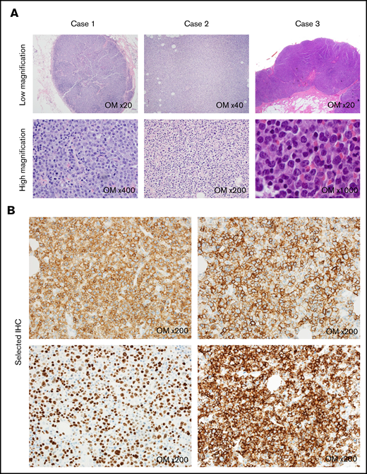 Representative hematopathology findings of incidentally discovered Richter transformation. (A) Images of hematoxylin and eosin–stained slides for each case. Original magnification (OM) is listed in each panel. (B) Immunohistochemistry (IHC) demonstrating CD5-positive (top left panel) and CD23-positive (top right panel) large atypical lymphocytes, as well as a Ki-67 proliferation index of 80% to 90% (bottom left panel) and strongly positive programmed death 1 staining (bottom right panel) in case 2.