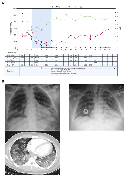 Patient’s clinical and radiographic findings. (A) Cell counts and inflammatory markers throughout the patient’s hospital stay, from day of presentation to discharge. Top, The shaded area indicates time requiring mechanical ventilation. Left y-axis, WBC and platelet (Plt) counts in cells ×103 per microliter. Right y-axis, Hgb in grams per deciliter. Bottom, Patient’s antileukemic treatment included methylprednisolone, vincristine, and daunorubicin; timing staggered per clinical discretion. Systemic steroid therapy was started on HD 5, for a total course of 28 days. Vincristine was given on HD 12 and continued weekly for 4 doses. Daunorubicin was given on HD 19 and continued weekly for 4 doses. Treatment continued in the outpatient setting after hospital discharge, and additionally included 1 dose of polyethylene glycol (PEG)–aspargase. aIL-1β, IL-4, IL-5, IL-10, IL-12, IL-13, IL-17, interferon γ, and tumor necrosis factor α also tested without elevation in levels. bMaximum temperature (Tmax) recorded that calendar day. Normal reference values per reporting laboratory: C-reactive protein (CRP), 0-10 mg/L; ferritin, 30-400 ng/mL; IL-6, <5 pg/mL; sIL-2, <1033 pg/mL. (B) Chest radiograph and computed tomography scan at time of presentation (left), showing patchy consolidation and characteristic ground-glass pulmonary infiltrates throughout the lungs, predominant in the lower lobes. Chest radiograph 2 months later (right), showing resolution of consolidation.