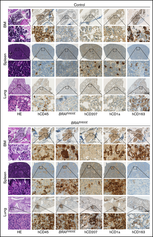 Expression of BRAFV600Ein human HSPCs induces Langerhans cell histiocytosis-like disease in MISTRG mice. Immunohistologic staining of BM, spleen, and lung of representative MISTRG mice, transplanted with Ctrl.-GFP or BRAFV600E-GFP transduced human CB HSPCs and analyzed 5 weeks later. Areas of magnification are indicated by respective squares. Scale bars represent 2 different magnifications. H&E, hematoxylin and eosin; hCD45, anti-human lymphocyte common antigen; BRAFV600E, monoclonal antibody against BRAFV600E.