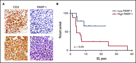 High PARP-1 expression in MF correlates with poor OS. (A) Representative IHC samples of the skin biopsy from a patient with MF with equal CD3 and low PARP-1 (top panels) and high PARP-1 (bottom panels) expression (original magnification, ×40). (B) Kaplan-Meier curves of OS (years) of patients with MF having a low PARP-1 IHC score (<50) vs high PARP-1 IHC score (>50) (n = 25). Log-rank (Mantel-Cox) test (P < .05).
