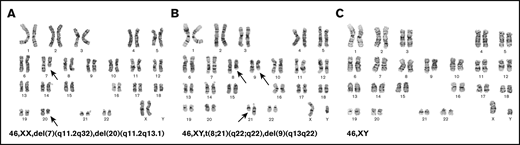 Cytogenetic abnormalities identified during the course and treatment of the disease. (A) At diagnosis, the female patient was identified to have karyotypic abnormalities consistent with MDS with deletion 7q and del 20q. (B) After allogeneic stem cell transplantation, she was found to have a donor-derived AML with t(8;21). (C) After her second allogeneic stem cell transplantation, she was found to have another AML with normal karyotype.