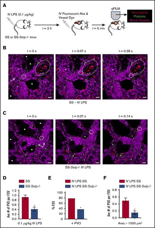 Genetic deletion of P-selectin attenuates pulmonary vaso-occlusion in SCD mice. (A) SS and SS-Selp−/− mice were challenged IV with 0.1 µg/kg LPS, and qFILM was used 2 to 2.5 hours later to visualize the pulmonary microcirculation. (B) IV LPS (0.1 µg/kg) triggered occlusion of pulmonary arteriolar bottlenecks (large dotted ovals) in SS mice by large aggregates of neutrophils (red) and platelets (green). The same FOV is shown over 3 time points. A neutrophil (red; small dashed circles) flows toward the occlusion but cannot pass through it and is forced to flow toward another open vessel to the side of the occlusion. Supplemental Video 1 shows the complete time series for the FOV in panel B. (C) In contrast to SS mice, the majority of FOVs in SS-Selp−/− mice were free of pulmonary vaso-occlusions. The same FOV is shown over 3 time points. A neutrophil (red; small dashed circles) is seen trafficking up the pulmonary arteriole that has no aggregates present. Supplemental Video 2 shows the complete time series for the FOV in panel C. The pulmonary microcirculation was labeled with FITC-Dextran and pseudo-colored purple. Neutrophils and platelets were labeled by IV administration of AF546-conjugated anti-Ly6G mAb and V450-conjugated anti-CD49b mAb, respectively. Neutrophils are shown in red, and platelets are pseudo-colored green. The arrows denote the direction of blood flow, and the asterisks (*) denote alveoli. Scale bars, 20 μm. The diameters of the vessels are 34 μm and 40 μm in panels B-C, respectively. (D-F) The neutrophil-platelet aggregates blocking pulmonary arterioles were quantified as described in Methods. After IV LPS administration, SS-Selp−/− mice had a significantly decreased average number of pulmonary vaso-occlusions per FOV (D), percentage of FOVs with pulmonary vaso-occlusions (E), and large pulmonary vaso-occlusions (area >1000 μm2) (F) compared with SS mice. The average number of pulmonary vaso-occlusions per FOV and large pulmonary vaso-occlusions (area >1000 µm2) were compared between groups using the unpaired Student t test, and the percentage of FOVs with pulmonary vaso-occlusions were compared between groups using fourfold table with χ2 analyses. SS mice: n = 1 male mice and 2 female mice, FOV = 45. SS-Selp−/− mice: n = 1 male mice and 2 female mice, FOV = 46. Error bars are mean ± SE. *P < .05.