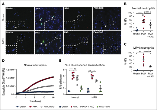 NETs are reduced by NAC in MPN patients. (A) Representative immunofluorescence images of NETs from normal and MPN individuals. H3cit is shown in green, and DAPI-stained DNA is shown in blue. Arrows represent H3cit+ NETs. Bars represent 50 μm. Original magnification ×40. (B-C) Quantification of NETs from normal individuals (B) or patients with MPN (C) upon stimulation with 10 nM PMA and PMA + NAC; **P < .01, ****P < .0001 1-way ANOVA. (D) Representative time course of extracellular DNA via RFUs as measured by the nucleic acid dye SYTOX. (E) Quantification of RFUs normalized to unstimulated normal neutrophils. The inhibitor diphenyleneiodonium (DPI) was used as a positive control for NET inhibition. Each point represents an individual; *P < .05, ***P < .001, ****P < .0001, Student t test. Error bars represent SEM. Shown are representative data from 3 biological replicates.