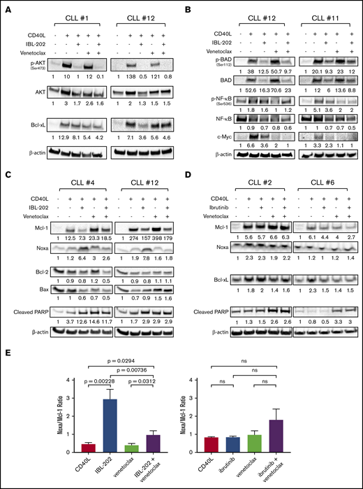 IBL-202 and venetoclax inhibit PI3K signaling and downregulate expression of Bcl-2 family proteins. Expression of phosphorylated and total AKT and Bcl-xL (n = 8) (A) and phosphorylated and total Bad and NF-κB and c-Myc (n = 6) (B) was assessed by immunoblotting in primary CLL cells cultured in medium alone or cocultured with CD40L fibroblasts. CLL cells in coculture with fibroblasts were treated with IBL-202 (1 μM) or venetoclax (10 nM), alone or in combination. Levels of Mcl-1, Noxa, Bax, Bcl-2, Bcl-xL, and PARP were assessed by immunoblotting of primary CLL cells treated with IBL-202 (1 μM) and venetoclax (10 nM), alone or in combination (n = 6) (C), and ibrutinib (0.5 μM) or venetoclax (10 nM), alone or in combination (n = 3) (D). Representative data from 2 patient samples are shown in panels A-D. The values shown under each lane indicate the fold change in expression relative to an untreated control for each patient sample. (E) Histograms show the cumulative data of the Noxa/Mcl-1 expression ratio in CLL cells treated with IBL-202 (n = 6) or ibrutinib (n = 3), alone or in combination with venetoclax. ns, not significant.