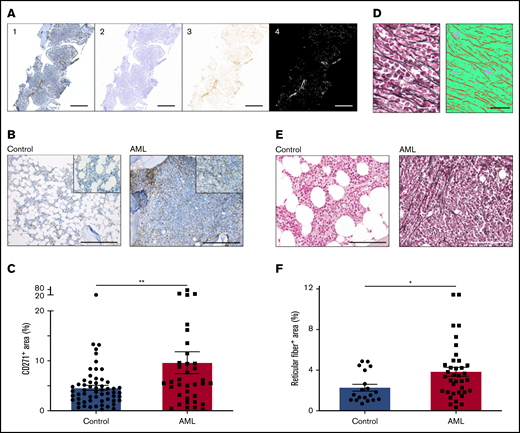 AML infiltration induces proliferation of bone marrow MSPCs. (A) Exemplary procedure for quantification of CD271. First, tile images were fused into larger images (1). Second, a color deconvolution was performed (ImageJ, IHC Profiler plugin) to obtain separate hematoxylin and DAB images. The hematoxylin image was thresholded to obtain a mask of the total bone region (2). The DAB image (3) was inverted and thresholded to obtain a mask of the positive DAB regions (4). Scale bars, 1 mm. (B) Representative images of bone marrow biopsy samples of non-leukemic donors (controls) and AML patients stained for CD271+ MSPCs (brown) and counterstained with hematoxylin (blue). Scale bars, 400 µm. (C) Quantification of CD271+ bone marrow MSPCs in controls (n = 58) and AML patients (n = 36); CD271+ area is calculated by CD271+ stained area divided by total tissue surface. (D) Left: representative image from bone marrow after silver staining representing reticular fibers. Right: image converted by trainable Weka segmentation showing 3 different classes: red, reticular fiber; green, tissue; purple, background. Scale bars, 50 µm. (E) Representative images of bone marrow biopsy samples from controls and AML patients stained for reticular fibers with silver staining (black fiber) and counterstained with the fast-red nuclear solution. Scale bars, 100 µm. (F) Quantification of reticular fibers in control (n = 19) and AML (n = 37) bone marrow by calculating positive silver stained area divided by total tissue surface (n = 56). Data are shown as mean ± standard error of the mean (SEM). *P < .05; **P < .01 (determined by Mann-Whitney U test).