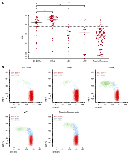 Percentage of MO1s in the 233 cases grouped by disease. (A) Flow cytometry results are shown as the percentage of MO1 identified for the 5 groups analyzed (39 OM-CMML, 54 CMML, and 23 MDS that did not meet OM-CMML diagnostic criteria; 15 MPN with ≥1 × 109/L monocytes, and 102 reactive monocytosis). Each dot represents a patient result for the MO1 test, and lines represent the median percentage for each disease group. The dotted line indicates the 94% cutoff of the test. ***P < .001. (B) The distribution of monocyte subsets is shown for 5 examples, each one from a different disease group. The percentage of the 3 monocyte subsets (MO1, MO2, and MO3) out of the total monocytes is displayed for each example. ns, not significant.