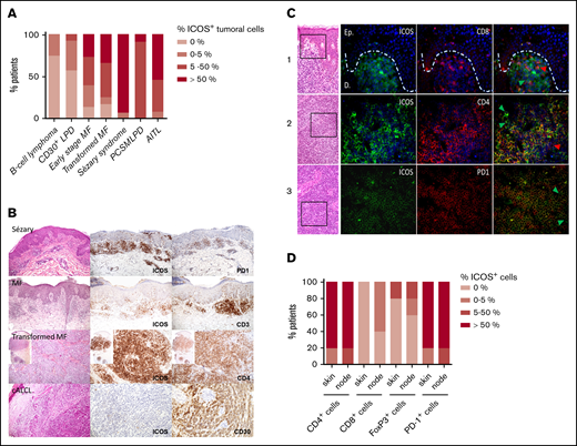 ICOS expression by malignant T cells in CTCL skin biopsy specimens at different disease stages. (A) Percentage of patients with ICOS+ tumoral cells, determined by immunohistochemical analysis of ICOS expression in skin samples of 23 patients with early-stage MF, 12 with transformed MF, 17 with SS, 12 with B-cell lymphoma, 14 with CD30+ LPD (cutaneous anaplastic large cell lymphoma and lymphomatoid papulosis), 12 with PCSMTLPD, and 13 with AITL. Cutaneous B-cell lymphoma skin samples were used as negative controls, whereas PCSMTLPD and AITL were positive controls. (B) Immunohistochemical analysis of the expression of ICOS in epidermal or dermal CD3+CD4+ infiltrating lymphocytes. (C) Double-staining experiments using immunofluorescence with anti-mouse Texas red anti-rabbit Alexa Fluor 488 as secondary antibodies and 4′,6-diamidino-2-phenylindole for nuclear staining in skin (line 1) and lymph node samples (lines 2 and 3) from 3 different patients with SS. Arrowheads identify cells with a single-marker expression; green arrowheads show ICOS+ cells, and red arrowheads show CD8+ cells (line 2) and CD4+ cells (line 3). (D) Double-staining immunohistochemical analysis of skin and node samples of 5 patients with SS. The percentage of patients with ICOS+/CD4+, ICOS+/CD8+, ICOS+/FoxP3+, and ICOS+/PD-1+ cells in the skin and node tumoral infiltrate is represented. cALCL, cutaneous anaplastic large cell lymphoma.