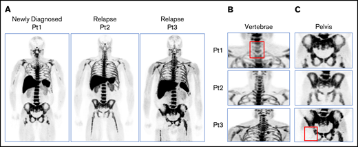 64Cu-daratumumab biodistribution in subjects imaged without preinfusion of unlabeled daratumumab. (A) Maximum intensity projections showing diffuse 64Cu-daratumumab uptake in the liver, spleen, spine, and pelvis among the 3 patients. Magnification of the cervical (B) and pelvic (C) regions showing reduced radiotracer uptake (red squares) in regions corresponding to the sites in which patient 1 and patient 3 received palliative radiation. pts, patients.