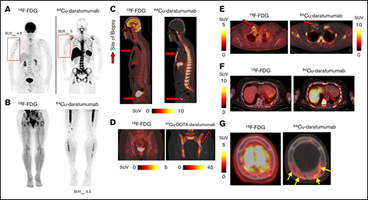 Comparison of64Cu-daratumumab with18F-FDG. (A-B) Maximum intensity projections comparing the uptake of 64Cu-daratumumab with 18F-FDG. Similar skeletal uptake in the right humerus for both tracers was observed (red rectangles) in patient 1 (A), while 64Cu-daratumumab, but not 18F-FDG uptake in the femur and fibula (SUVmax 3.3), was observed in patient 7 (B). (C) Sagittal cross-section through scans comparing 64Cu-daratumumab and 18F-FDG uptake in 2 regions (sternum and pelvis, red arrows) found positive for MM infiltration by biopsy. (D) Heterogeneous pelvis uptake of 64Cu-daratumumab in the region that was found positive for MM by biopsy (red arrow), but negative by 18F-FDG. (E) Biopsy acquired (red arrow) from patient 2 with right clavicular uptake on 18F-FDG but not on 64Cu-daratumumab, which was negative for MM infiltration upon biopsy. (F) Sagittal cross-section through scans comparing 64Cu-daratumumab and 18F-FDG uptake in another patient showing elevated 18F-FDG and no 64Cu-daratumumab uptake in the pleural-based mass, a region indicated to be myeloma-negative by biopsy. (G) Prominent calvarial uptake (yellow arrows) around bone lesions was seen in the 64Cu-daratumumab PET images of patient 1, which is typically obscured by the brain uptake of 18F-FDG. Color bars are shared between the 18F-FDG PET and 64Cu-DOTA–daratumumab PET images when 1 color bar is grouped with a pair of images.
