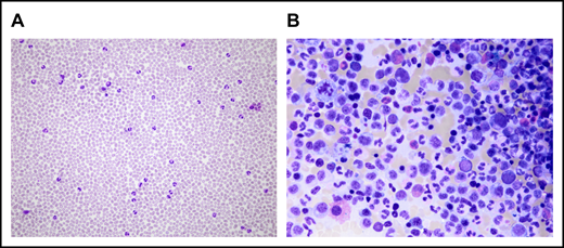 Microscopical analysis of PB and BM at CNL diagnosis. (A) Neutrophilia in PB. (B) BM examination shows hypercellularity resulting from proliferation of the myeloid lineage without an increase in myeloblasts. The pictures were acquired by a Leica DM4B widefield microscope equipped with an Olympus UC90 camera: original magnification ×20 (A) and ×50 (B), respectively; May-Grünwald-Giemsa stain. The images were taken at room temperature using immersion oil. For acquisition, Cell sense Entry software was used; the images were subsequently annotated using ImageJ.
