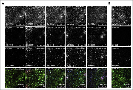 Labeled thrombin-activatable fibrinolysis inhibitor (TAFI) localized to both C-terminal lysine exposed fibrin fibers and the surfaces of activated platelets. (A) Representative sequential (a-e at the indicated times) high magnification images (63× objective) of Alexa Fluor 488-labeled fibrinogen (fbg-488, top, green), Alexa Fluor 568-labeled plasminogen (plg-568, second from top, red), and Alexa Fluor 647-labeled TAFI (TAFI-647; third from top, blue). (B) Images of fbg-488, plg-568, TAFI-647, and overlay at 20 minutes, 40 seconds from the start of video capture, in the presence of 1 mM ε-aminocaproic acid, a lysine analog.