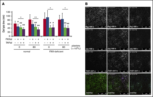 Cross-linkage between thrombin-activatable fibrinolysis inhibitor (TAFI) and fibrin is not necessary for TAFI function. (A) Activated factor XIII inhibitor (FXIIIaI; R283, an irreversible inhibitor against FXIIIa), at 1 mM, and/or activated TAFI inhibitor (TAFIaI), at 5 µM, were added to normal (n = 7) or FXIII-deficient plasma (n = 5), with or without washed normal platelets. Tissue-type plasminogen activator (tPA, 1.5 nM)-induced plasma clot lysis times were determined and are presented as the average ± SD. Significant differences were analyzed using Student t test (#P < .05, ##P < .01 vs control, +P < .05, ++P < .01 R283 vs R283 and TAFIaI). (B) Representative sequential high magnification (63× objective) images of Alexa Fluor 488-labeled fibrinogen (fbg-488, top, green), Alexa Fluor 568-labeled plasminogen (plg-568, second from top, red), and Alexa Fluor 647-labeled TAFI (TAFI-647, third from top, blue) in normal platelet-containing FXIII-deficient plasma. Clot lysis was initiated by the addition of tPA (2 nM).