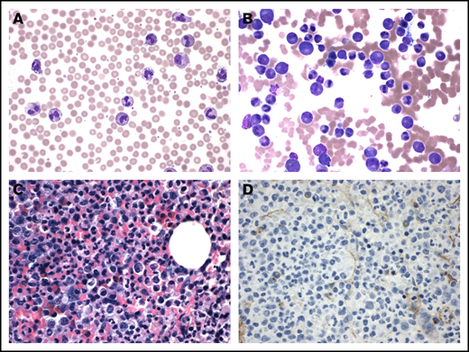 CNL characterized by increased neutrophils and myeloid hyperplasia. The peripheral smear shows prominent neutrophilia (A; original magnification ×600; Wright's stain). The accompanying bone marrow aspirate illustrates myeloid hyperplasia with complete maturation (B; original magnification ×600; Wright's stain). The core biopsy is hypercellular and dominated by maturing myeloid elements (C; original magnification ×600) with no increase in CD34-positive blasts (D; original magnification ×600; hematoxylin and eosin stain).