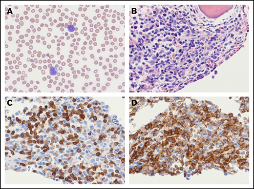 B-LBL arising out of CNL. The peripheral smear demonstrates circulating blasts with single to multiple prominent nucleoli (A; original magnification ×600; Wright's stain). The bone marrow biopsy is markedly hypercellular with an increase in blasts (B; original magnification ×600; hematoxylin and eosin stain). By immunohistochemistry, the blasts coexpress CD79a (C; original magnification ×600) and CD34 (D; original magnification ×600).
