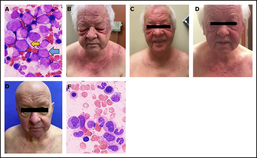 Significant improvements in physical examination findings and bone marrow aspirates of DM with allo-HCT. (A) Bone marrow aspirate prior to chemotherapy (1000× magnification, Wright-Giemsa stain): MDS with excess blasts-2 (MDS:EB2). Blue arrow, myeloblast; black arrow, hypogranular neutrophil; yellow arrow, proerythroblast. (B) Dermatologic findings prior to beginning chemotherapy (C), following 3 cycles of chemotherapy (D), following 6 cycles of chemotherapy and prior to allo-HCT (E), and 8 weeks following allo-HCT. (F) Bone marrow aspirate post–allo-HCT (1000× magnification, Wright-Giemsa stain): normal morphology for granulocytes and erythroid precursors.