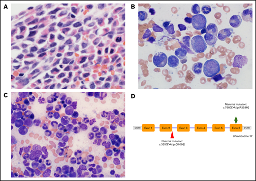 Diagnostic micrographs of the patient’s bone marrow biopsy specimen and aspirates and genetic mutation. (A) Wright-Giemsa–stained low-power view of diagnostic patient bone marrow biopsy specimen before initiation of G-CSF administration showing hypercellularity with left-shifted myeloid maturation. Original magnification ×400. (B) Wright-Giemsa stained high-power view of bone marrow aspirate demonstrating vacuolization of myeloid precursors and pyknotic nuclei (2% myeloblasts, 12% promyelocytes, 26% myelocytes, 26% metamyelocytes, 8% bands, 9% segmented neutrophils). Original magnification ×1000. (C) High-power view of bone marrow aspirate after chronic G-CSF administration showing improved myeloid maturation (2% promyelocytes, 10% myelocytes, 11% metamyelocytes, 20% bands, 36% segmented neutrophils). Original magnification ×600. (D) Biallelic patient gene mutation showing compound heterozygous mutations in the G6PC3 gene. The paternal mutation at the terminus of exon 2 is a novel pathogenic variant that has not been described previously.