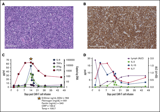 Pre–CAR-T diagnostic biopsy, CD30CAR-T expansion, and detection of homeostatic cytokines. Hematoxylin and eosin stain (A; scale bar, 100 μm) and CD30 antibody stain of the tumor biopsy before CAR T-cell therapy (B; scale bar, 200 μm). (C) Detection of CD30 CAR T-cell molecular signals by quantitative polymerase chain reaction (qPCR) and of the indicated cytokines over the course of the first 6 weeks after infusion. The star indicates evaluation of the listed parameters during the CRS event. (D) Detection of IL-2, IL-7, and IL-15 in the plasma and lymphocyte counts over the course of the first 6 weeks after infusion. ALC, absolute lymphocyte count; CRP, C-reactive protein; DDU, D-dimer unit; IFNg, interferon-γ; TNFa, tumor necrosis factor-α.