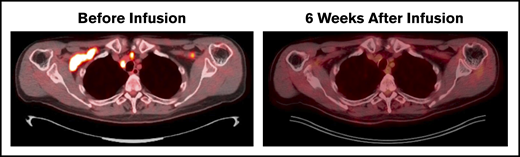 Durable CR after CD30 CAR T-cell therapy. Patient with multiply relapsed EATL. Before lymphodepletion and CD30 CAR T-cell infusion, disease involved the bilateral cervical, supraclavicular, mediastinal, hilar, and a single mesenteric lymph node. Six weeks after infusion, the patient achieved a Deauville score of 1 and CR. Additional disease assessments at 6, 12, and 24 months have continued to show CR.