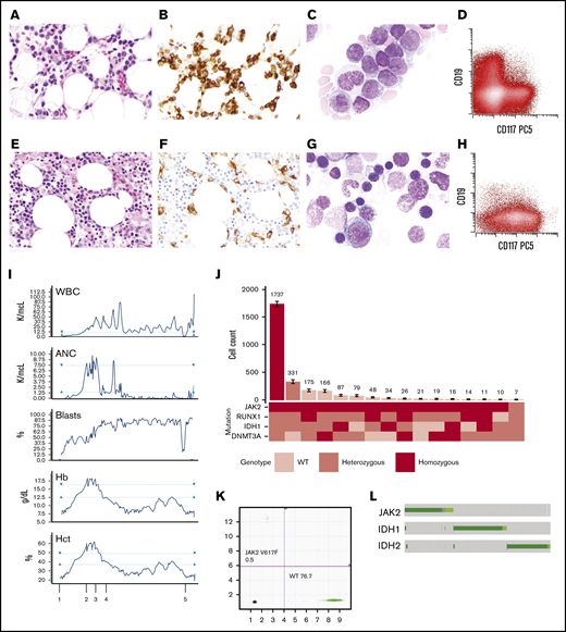 Evolution and emergence of a dominant JAK2V617Fand IDH1R132Cco-mutant clone induced by ivosidenib. Bone marrow morphology with hemoxylin and eosin stain (A), CD34 immunostain (B), Wright-Giemsa stain of bone marrow aspirate (C), and immunophenotype of the leukemic blasts (D) before initiating IDH inhibitor treatment. Bone marrow morphology with hemoxylin and eosin stain (E), CD34 immunostain (F), Wright-Giemsa stain of bone marrow aspirate (G), and immunophenotype of the leukemic blasts (H) following treatment with ivosidenib. (I) Timeline of complete blood count results in relation to therapy: 1, start of ivosidenib; 2 and 3, therapeutic phlebotomy; 4, decitabine/ruxolitinib; and 5, low-dose cytarabine/venetoclax. (J) Clonal architecture analysis using single-cell sequencing. Bar plot (top) depicts the number of cells identified with a given genotype (bottom) ranked by decreasing frequency of the clone. Cell counts for each clone is depicted with error bars derived from random resampling analysis. (K) Droplet digital PCR results on the marrow before IDH inhibitor treatment. (L) Illustration of JAK2, IDH1, and IDH2 mutational exclusivity patterns in AML from cBioportal. ANC, absolute neutrophil count; Hct, hematocrit; PCS, phycoerythrin-Cy5; WBC, white blood cell; WT, wild-type.