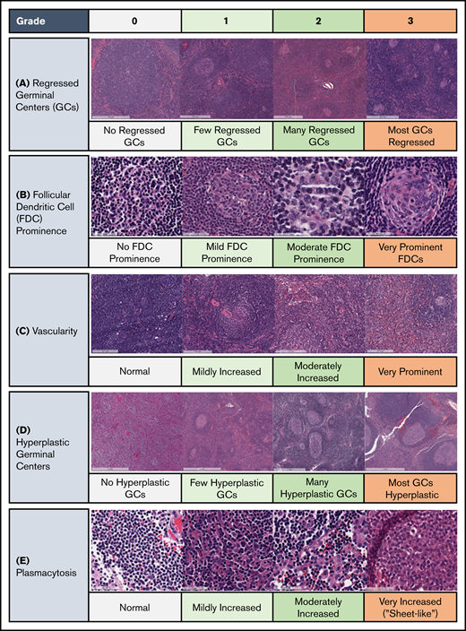 Spectrum of histopathological changes seen in UCD. HV histopathological subtype is characterized by the presence of regressed germinal centers (GCs) and FDC prominence, whereas the plasmacytic subtype exhibits hyperplastic GCs and profuse plasmacytosis. Mixed subtype exhibits a combination of HV and plasmacytic features. Lymph node slides were obtained prestained with hematoxylin and eosin from clinical specimens for the ACCELERATE natural history registry, scanned, and captured using Aperio Imagescope. Bars represent 60 (A,E) and 200 mm (B-D). (A) Regressed GC. (B) FDC prominence in GC. (C) Blood vessels penetrating GC demonstrate prominent vascularity. (D) Hyperplastic GC. (E) Sheet-like plasmacytosis.