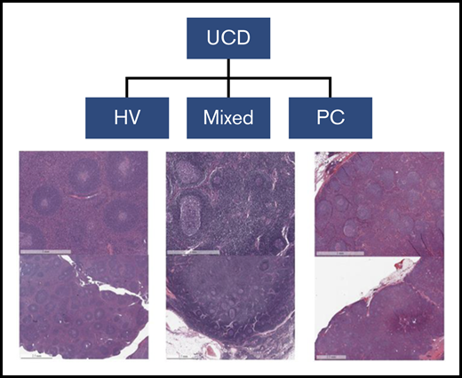 Representative examples of UCD. HV subtype is characterized by the presence of regressed atretic germinal centers. There is increased vascularity with hyalinization, prominence of often dysplastic FDCs, and expanded mantle zones in an onion-skin appearance. There are radially penetrating blood vessels causing a lollipop appearance, multiple germinal centers within the same mantle zone referred to as twinning or budding, tight aggregates of plasmacytoid dendritic cells, and architectural disruption with obliterated sinuses. PC subtype exhibits hyperplastic germinal centers and profuse plasmacytosis. Mixed subtype exhibits a combination of HV and PC features.
