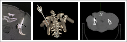 CT imaging confirming successful localization of the BM needle (arrowed) into the RM right posterior superior iliac crest. Following 10-Gy TBI, RM were anesthetized, and a BM needle was placed into proper position in the IB marrow space prior to CD34+ cell infusion.