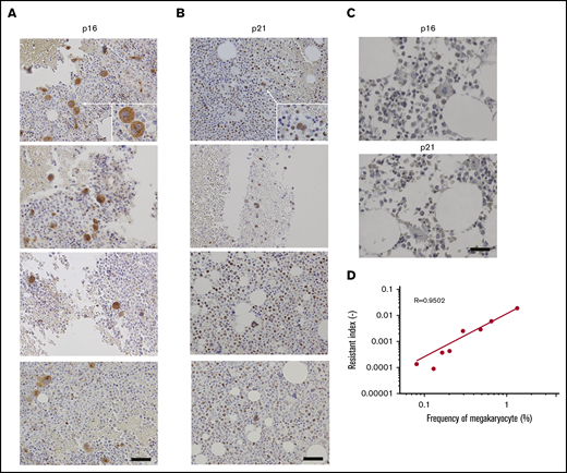 Correlation between TKI resistance and BM megakaryocyte numbers. Immunohistochemical staining for p16 (A) and p21 (B) in the BM biopsy specimens from four individual patients with CML are shown here. Images were obtained using a BX50 microscope using a ×20 objective lens. Scale bars, 20 μm. (C) Immunohistochemical staining for p16 and p21 in the healthy BM biopsy specimens. Representative results from 4 individual samples are shown. Images were obtained with a BZ-X700 microscope. Scale bars, 20 μm. (D) TKI-resistant index and megakaryocyte proportion in total BM cells in CML patients treated with imatinib or nilotinib. Pearson’s correlation coefficient was calculated and the actual R value is shown.