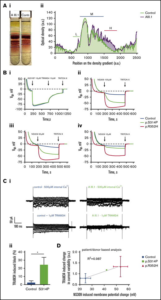 Functional tests of the new Gardos channel mutation p.S314P and relation to the mutation p.R325H. (A) Percoll density centrifugation of a blood sample from patient AIII.1 compared with a control subject. A methodologic description is given in the supplemental Material. (Ai) Image of the centrifuged tubes. (Aii) Profile of the cell distribution derived from intensity-based analysis of the image shown in panel Aa. Distance zero refers to light cells on top of the tube, and distance 2500 refers to the lowest measurable position in the tube. Low-density (L), medium-density (M), and high-density (H) fractions are marked with green, dark blue, and red bars, respectively. (B) Membrane potential measurements in RBC suspensions using the carbonyl cyanide-m-chlorophenylhydrazone method reported by Macey et al.15 A detailed description is provided in the supplemental Material. (Bi) Within approximately 3 minutes, RBCs reach an equilibrium at the RBC resting membrane potential of −10 mV. When the Ca2+ transporter A23187 at a concentration of 10 µM in the presence of 4 μM Ca2+ is added (equivalent to full Gardos channel activation), membrane potential drops immediately to approximately −80 mV due to the induced K+-conductance. Repolarization is accelerated when 10 µM of the Gardos channel inhibitor TRAM34 is added. Upon addition of TRITON X-100, which lyses the RBCs, a membrane potential no longer exists (0 mV). Here, mutated cells (KCNN4 p.S314P) react the same as healthy RBCs. (Bii) Within approximately 3 minutes, added RBCs reach an equilibrium at the RBC resting membrane potential of −10 mV. When 100 µM of the Gardos channel activator NS309 is added, the membrane potential of the healthy RBCs drops to approximately −15 mV, whereas in the mutated cells, the membrane potential reaches almost −50 mV (p.S314P) and −70 mV (p.R352H), hinting to gain-of-function mutations in both variants. At the end, TRITON X-100 is added to get the 0 mV calibration. Panels Biii and Biv are experiments performed in analogy to panel Bb but with the addition of 50 µM and 10 µM NS309, respectively. Blue lines represent normal control, green lines p.S414P mutated cells, and red lines p.R352H KCNN4 variant. (C) Whole-cell recordings of the Gardos channel currents from RBCs of a healthy subject and patient AIII.1 (p.S314P). A detailed methodologic description is presented in the supplemental Material. Currents were elicited by voltage steps from −130 mV to 50 mV for 500 ms in 20 mV increments at Vh = −30 mV and recorded in the absence and after application of 1 μM TRAM34, a specific Gardos channel blocker. (Ci) Raw current traces from a healthy subject’s RBCs in the absence (top left) and in the presence (bottom left) of 1 μM TRAM34 as indicated above the recordings. For comparison, raw current traces from the patient’s RBCs in the absence (top right) and in the presence (bottom, right) of 1 μM TRAM34 as indicated above the recordings. Note that in this particular example, the background current in the healthy control subject is higher than in patient AIII.1. (Cii) Comparison of the percent block by 1 μM TRAM34 of the mean currents at −110 mV in the healthy and mutated RBCs. Significance was checked based on an unpaired Student t test, *P < .05. (D) Correlation of TRAM34-induced change in current variability vs NS309-induced membrane potential change for healthy controls and cells with mutations p.S314P and p.R352H. The statistical values are patient based. Values of p.S314P variant are taken from panels B and C. Patch clamp recordings of p.R352H are from Fermo et al10 (n1 = 23 cells) and 2 additional patients (n2 = 9 cells; n3 = 7 cells). NS309-induced potential changes were measured in three p.R325H patients (exemplified in panel Ca).