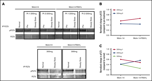 PIA shows gilteritinib is active against FLT3-ITD/F691L at clinically achievable plasma concentrations. (A) Western blot analysis for phosphotyrosine and total FLT3 performed after immunoprecipitation using anti-FLT3 antibody on lysates prepared from parental Molm14 cells and Molm14 cells expressing the FLT3-ITD/F691L mutation. Cells were exposed for 120 minutes to healthy normal control or pretreatment (pre) and steady-state plasma obtained from patients treated with gilteritinib at the 200 or 300 mg daily. Quantification of PIA data shown in panel A indicating reduction in normalized phospho-FLT3 (pFLT3) levels at steady-state timepoint compared with pretreatment (B) or normal (C) control plasma. Phosphotyrosine and total FLT3 band was quantified on a Licor Oddyssey imager and phosphotyrosine value was normalized to total FLT3 to derive normalized pFLT3 level. Data shown are ratios of steady-state to pretreatment normalized pFLT3 levels. Data represent a single experiment.