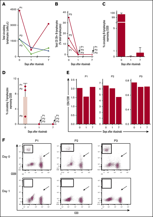 Rituximab leads to rapid and sustained elimination of circulating CD20+B and T lymphocytes despite ongoing TPEx in patients with iTTP. (A) Total circulating lymphocytes in patients with iTTP decrease after rituximab administration but there remains a variable response between the first and second dose of rituximab (days 1-7) and during continued TPEx. (B) Circulating CD20+ B lymphocytes vary in number in each patient. Rituximab removes nearly all circulating CD20+ B lymphocytes in each patient even after TPEx 24 hours later. The CD20+ B cells remain absent a week later at the time for the next rituximab treatment. (C) CD20+ is expressed on most circulating B lymphocytes in each patient at diagnosis. Rituximab quickly removes circulating CD20+ B lymphocytes within 24 hours. Recovery of CD20+ B lymphocytes by day 7 is patient-dependent, with patient 3 (P3) having the most circulating cells. (D) Specific circulating T lymphocytes in iTTP express CD20 and levels depend on the patient. Rituximab effectively depletes CD20+ T cells, which last 1 week after administration. (E) CD4-to-CD8 ratios are decreased between day 0 and day 1 in all patients, suggesting preferential depletion of CD4+ T cells. (F) Flow cytometry plots demonstrate that CD20+ B cells were eliminated (boxed regions) in each patient after rituximab treatment between day 0 and 1. The number of CD20+ T cells dropped dramatically (although to variable extent in different patients) within 24 hours after rituximab treatment (arrows). Bars and lines represent mean percentages plus standard deviation from N = 3 patients.