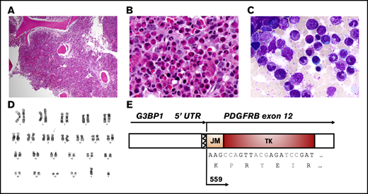 Histologic, cytogenetic, and molecular characteristics of the MLN-EO and a G3BP1-PDGFRB fusion. Hematoxylin and eosin–stained bone marrow core biopsy at low magnification (×4) (A) and high magnification (×40) (B), showing a hypercellular myeloid-predominant marrow with markedly increased eosinophilic forms. (C) May-Grünwald-Giemsa–stained bone marrow aspirate showing eosinophils in various stages of differentiation (magnification, ×100). (D) G-banding karyotype showing trisomy 8. (E) Schematic representation of the fusion transcript between the 5′UTR of G3BP1 and exons 12 of PDGFRB, detected by targeted AMP sequencing off RNA.