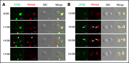 Coculture of huMkMPs and muHSPCs in vitro. muHSPCs were cocultured for up to 5 hours with huMkMPs stained with CFSE and PKH26. The cells were examined by confocal microscopy at 3 (A) and 5 (B) hours after the start of coculture, and fluorescence images were taken at different confocal planes. The numbers represent the specific slice (Z-stack) number (left)/total number of slices (right). Red arrows indicate huMkMPs binding to muHSPCs; white arrows indicate huMkMPs that have been internalized by muHSPCs.