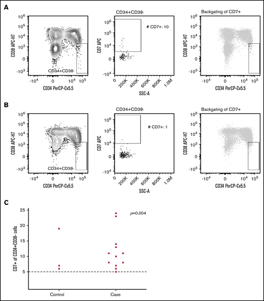 Flow cytometric analysis of aberrant CD7 expression within the stem cell subset. The CD34+CD38– stem cells were identified within the CD45lowSSClowCD14– cells (left panel), and the presence (A) or absence (B) of aberrant CD7+ cells were evaluated by using a bivariate plot of SSC-A vs CD7 (middle panel). The right panel displays backgating of CD7+ stem cells (black dots) into the CD45lowSSClowCD14–CD34+CD38- population (gray). (C) Absolute number of CD34+CD38– CD7+ cells according to case-control status. The dashed line denotes number of CD34+CD38– CD7+ cells required for aberrant CD7 expression. Five cells or more were regarded as a positive lower limit. Patients with <5 CD34+CD38– CD7+ cells are not shown as dots in the figure (case subjects, n = 20; control subjects, n = 33). The Pearson χ2 test was used to calculate P values, with the positive lower limit of 5 cells being the cutoff for yes/no for aberrant CD7 expression.