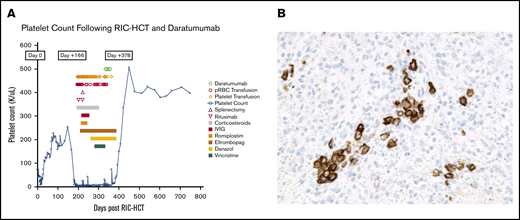 Platelet count trends and immunohistochemistry staining. (A) Patient’s platelet count after ITP treatment (including daratumumab) and transfusion needs. (B) CD138 immunohistochemical staining showed increased plasma cells in a spleen section.