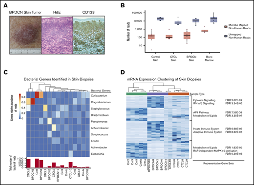 GATK-PathSeq analysis of BPDCN skin transcriptomes reveals normal cutaneous microbiota. (A) BPDCN skin tumor and biopsy stained with hematoxylin and eosin (H&E) and for CD123, representative of all BPDCNs sampled containing similar relative amount of tumor. Scale bars, 0.5 mm. (B) The number of GATK-PathSeq non-host microbe-mapped reads and non-host unmapped reads. (C) (Top) Genera relative abundance of GATK-PathSeq bacteria-assigned reads in skin samples. For clarity, only the top 10 genera are displayed. Samples are clustered with Euclidean distance based on the relative abundance of these 10 genera. (Bottom) Absolute number of GATK-PathSeq mapped reads assigned to the superkingdom bacteria in each sample (Cnt = normal skin). Color bar is genera relative abundance of reads. (D) Unsupervised hierarchical clustering using the 315 most differentially expressed human genes (rows) in the 15 skin samples (columns). Genes associated with each cluster were tested for enrichment in the c2.cp (canonical pathways) gene set deposited in the Molecular Signatures Database v7.0, and representative gene sets are displayed. FDR, false discovery rate; IFN, interferon; mRNA, messenger RNA.